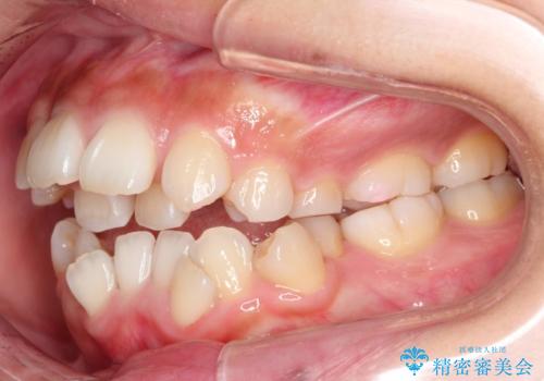 人生が変わる 困難を極める咬合状態に歯列矯正単独で挑戦するの治療前