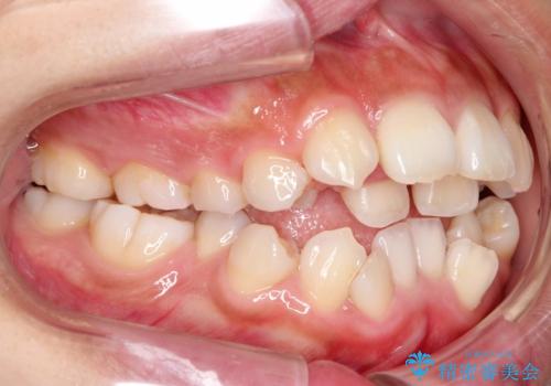 人生が変わる　困難を極める咬合状態に歯列矯正単独で挑戦するの治療前