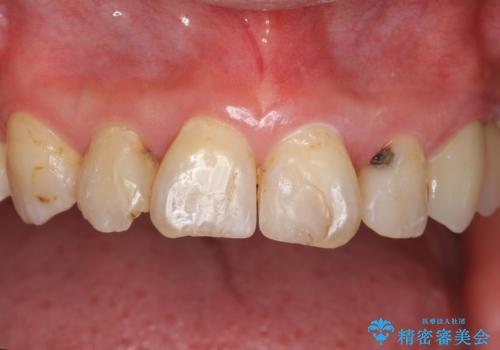 前歯の虫歯　つぎはぎの歯をセラミックにの症例 治療前