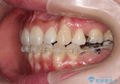 ハーフリンガル抜歯矯正　八重歯を改善するの治療中