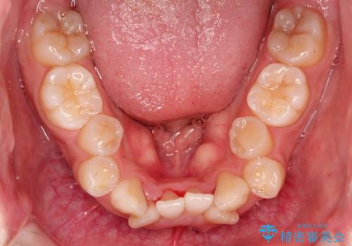 人生が変わる 困難を極める咬合状態に歯列矯正単独で挑戦するの治療前