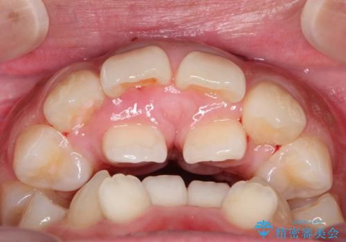 人生が変わる 困難を極める咬合状態に歯列矯正単独で挑戦するの治療前