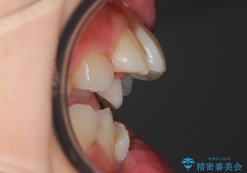 人生が変わる　困難を極める咬合状態に歯列矯正単独で挑戦するの治療前