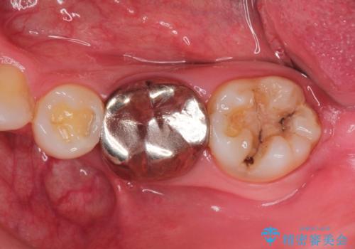[金属の詰め物内部にむし歯] 奥歯のセラミックインレーの治療前