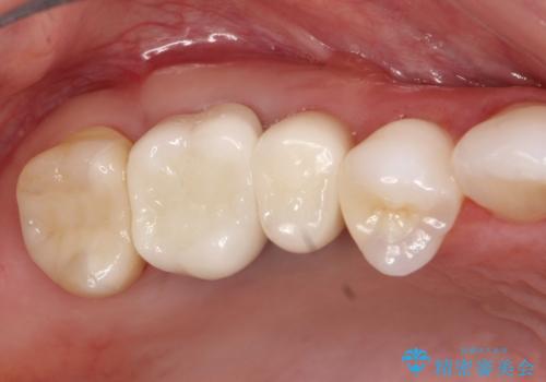 歯周外科・根管治療による長期予後を期待する奥歯の治療の治療後