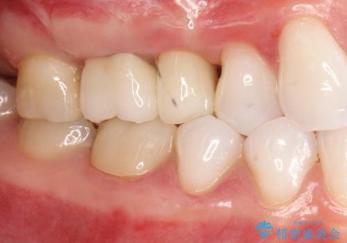 歯周外科・根管治療による長期予後を期待する奥歯の治療の治療後