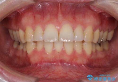 口が閉じずらく、口元出てるのが気になる　ワイヤー抜歯矯正による口元の改善の症例 治療前