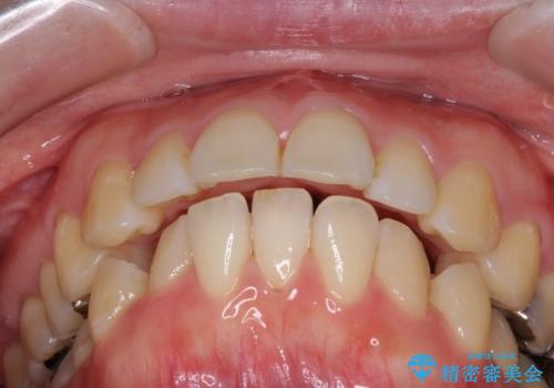 口が閉じずらく、口元出てるのが気になる ワイヤー抜歯矯正による口元の改善の治療前