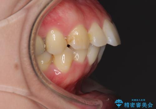 口が閉じずらく、口元出てるのが気になる ワイヤー抜歯矯正による口元の改善の治療前