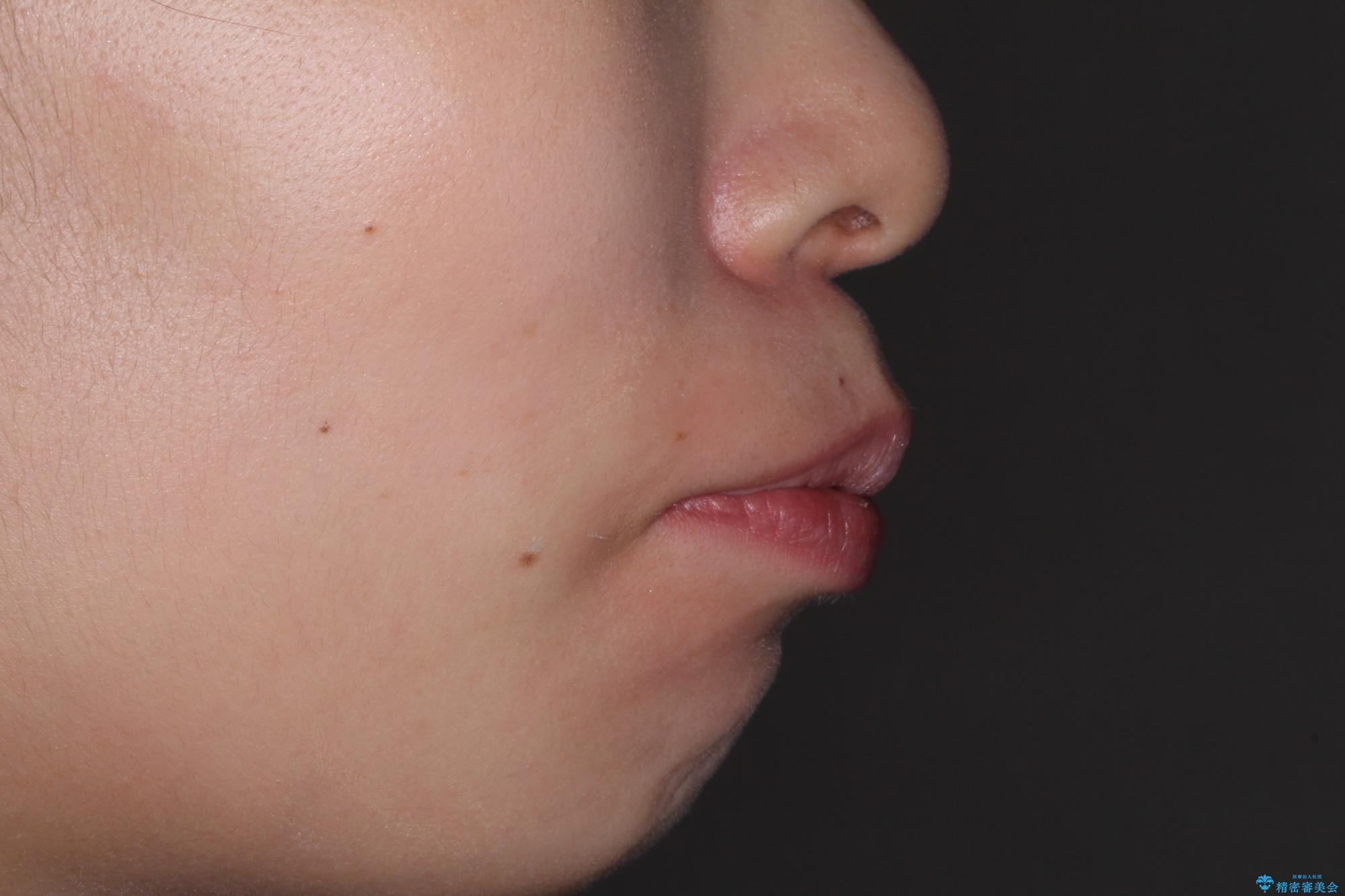 口が閉じずらく、口元出てるのが気になる ワイヤー抜歯矯正による口元の改善の治療前(顔貌)