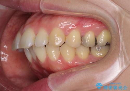 口が閉じずらく、口元出てるのが気になる ワイヤー抜歯矯正による口元の改善の治療前