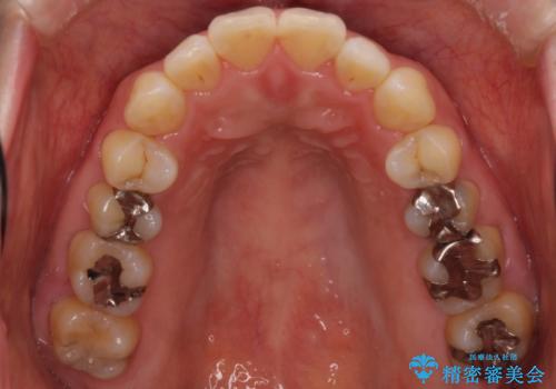 口が閉じずらく、口元出てるのが気になる ワイヤー抜歯矯正による口元の改善の治療前
