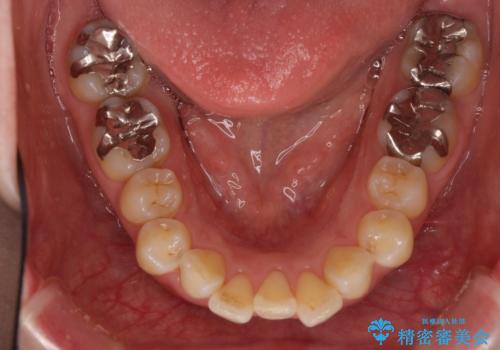 口が閉じずらく、口元出てるのが気になる　ワイヤー抜歯矯正による口元の改善の治療前