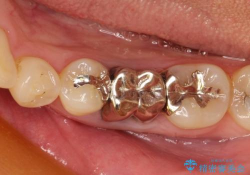 深い虫歯により抜歯となった奥歯　インプラント治療でかみ合わせを回復するの治療前