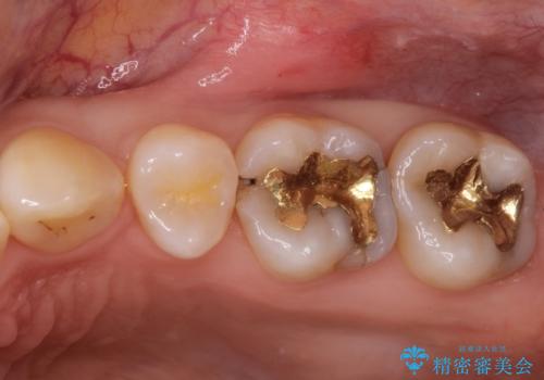 一度治療した歯が虫歯に セラミックインレーで治療の治療前