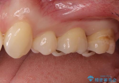 一度治療した歯が虫歯に セラミックインレーで治療の治療前