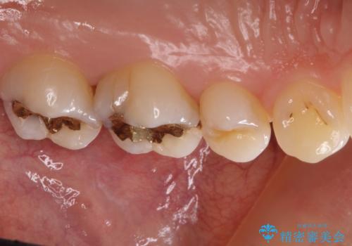 一度治療した歯が虫歯に セラミックインレーで治療の治療前
