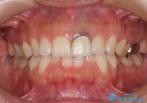 前歯のメタルをセラミックにしたい　歯自体が変色している場合の参考用の治療前