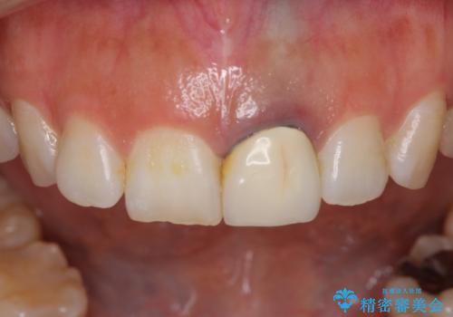 前歯のメタルをセラミックにしたい 歯自体が変色している場合の参考用の治療前