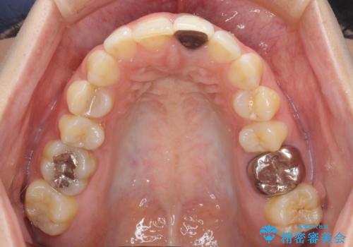 前歯のメタルをセラミックにしたい 歯自体が変色している場合の参考用の治療前
