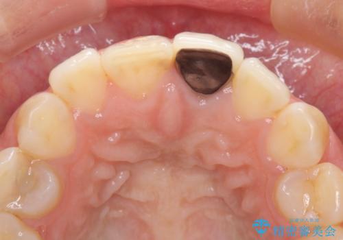 前歯のメタルをセラミックにしたい　歯自体が変色している場合の参考用の治療前
