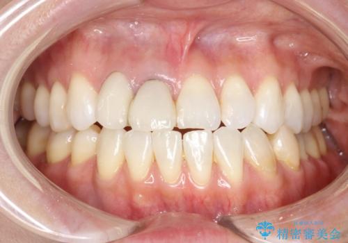 前歯がぐらぐらする　抜歯→ブリッジへ　の症例 治療前