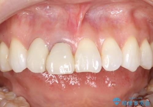 前歯がぐらぐらする 抜歯→ブリッジへ の治療前