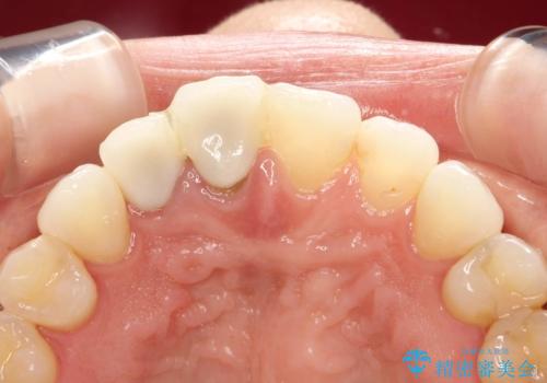 前歯がぐらぐらする　抜歯→ブリッジへ　の治療前