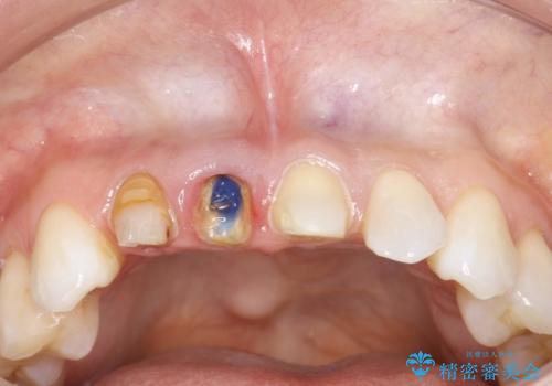 前歯がぐらぐらする 抜歯→ブリッジへ の治療中