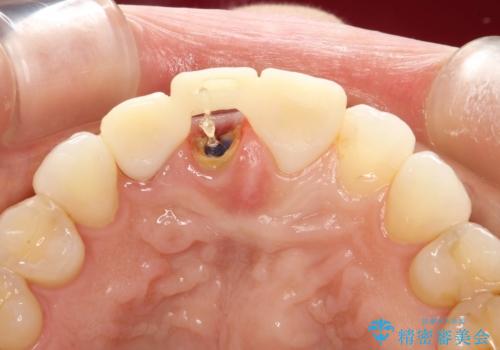 前歯がぐらぐらする　抜歯→ブリッジへ　の治療中