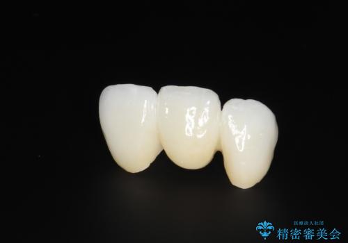 前歯がぐらぐらする 抜歯→ブリッジへ の治療後