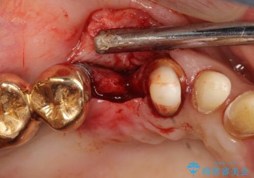 薄い骨にもインプラントを スプリットクレスト+ショートインプラントの応用の治療中