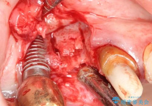 薄い骨にもインプラントを スプリットクレスト+ショートインプラントの応用の治療中