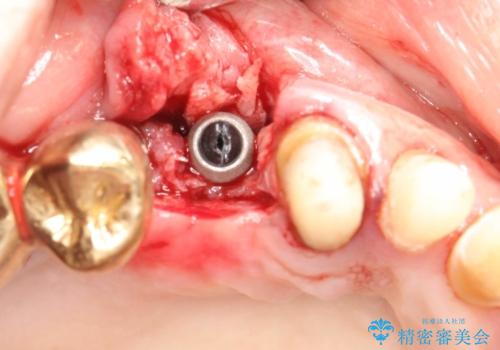 薄い骨にもインプラントを スプリットクレスト+ショートインプラントの応用の治療中