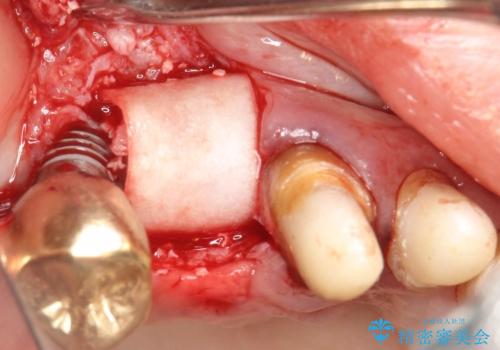 薄い骨にもインプラントを スプリットクレスト+ショートインプラントの応用の治療中