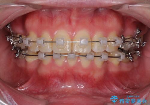 口が閉じずらく、口元出てるのが気になる　ワイヤー抜歯矯正による口元の改善の治療中