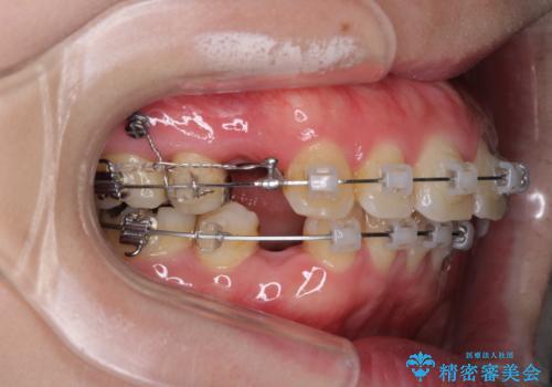 口が閉じずらく、口元出てるのが気になる ワイヤー抜歯矯正による口元の改善の治療中