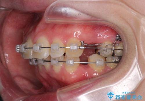 口が閉じずらく、口元出てるのが気になる ワイヤー抜歯矯正による口元の改善の治療中