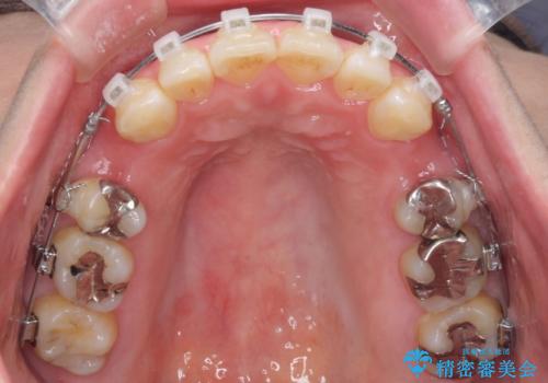 口が閉じずらく、口元出てるのが気になる ワイヤー抜歯矯正による口元の改善の治療中