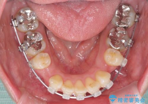 口が閉じずらく、口元出てるのが気になる　ワイヤー抜歯矯正による口元の改善の治療中