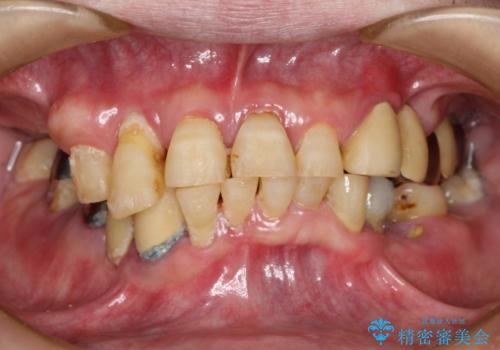 虫歯だらけ、歯周病　崩壊した口腔の再建　フルマウスリコンストラクションの症例 治療前