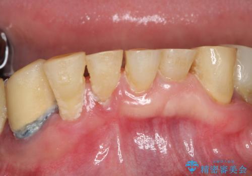 虫歯だらけ、歯周病 崩壊した口腔の再建 フルマウスリコンストラクションの治療前