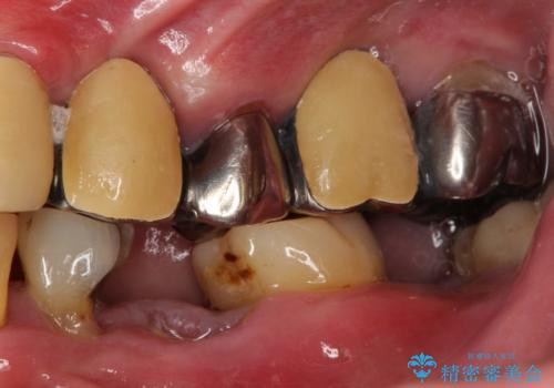 虫歯だらけ、歯周病 崩壊した口腔の再建 フルマウスリコンストラクションの治療前