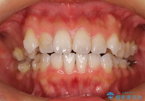 抜歯せずに八重歯のマウスピース矯正の治療中