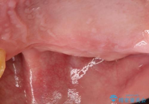 虫歯だらけ、歯周病 崩壊した口腔の再建 フルマウスリコンストラクションの治療前