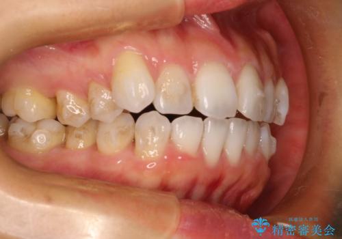 抜歯せずに八重歯のマウスピース矯正の治療中