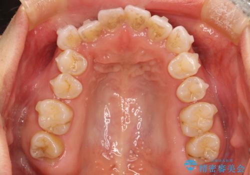 抜歯せずに八重歯のマウスピース矯正の治療中