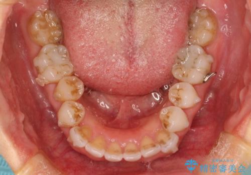 抜歯せずに八重歯のマウスピース矯正の治療中