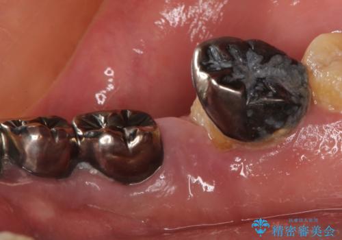 虫歯だらけ、歯周病 崩壊した口腔の再建 フルマウスリコンストラクションの治療前