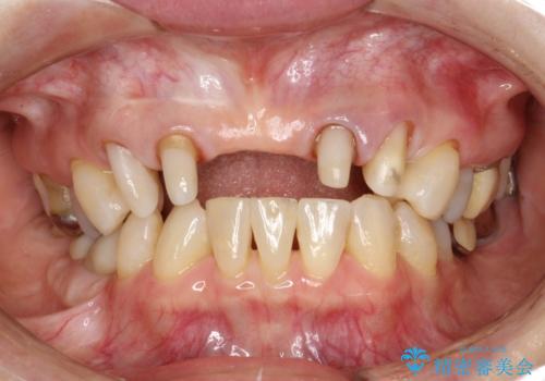 前歯のブリッジの見栄えが悪い→見えないところからしっかりとやり直しをの治療中